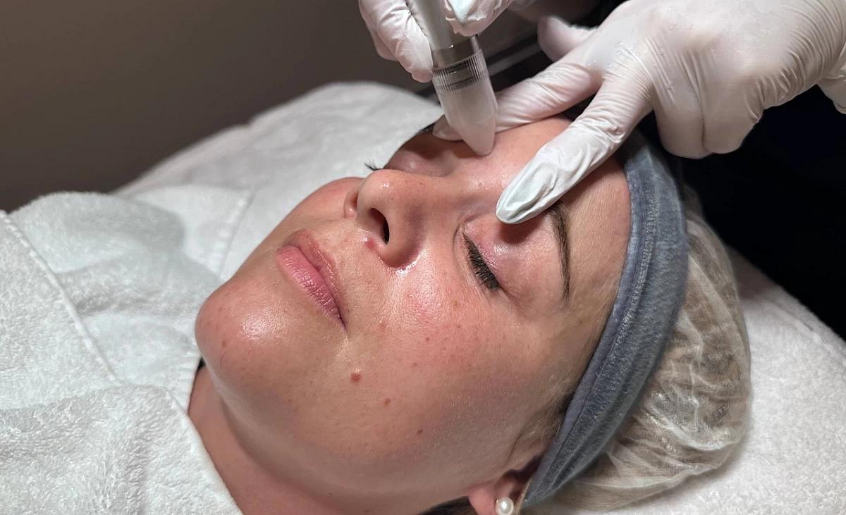 The face is exfoliated with the microdermabrasion device.