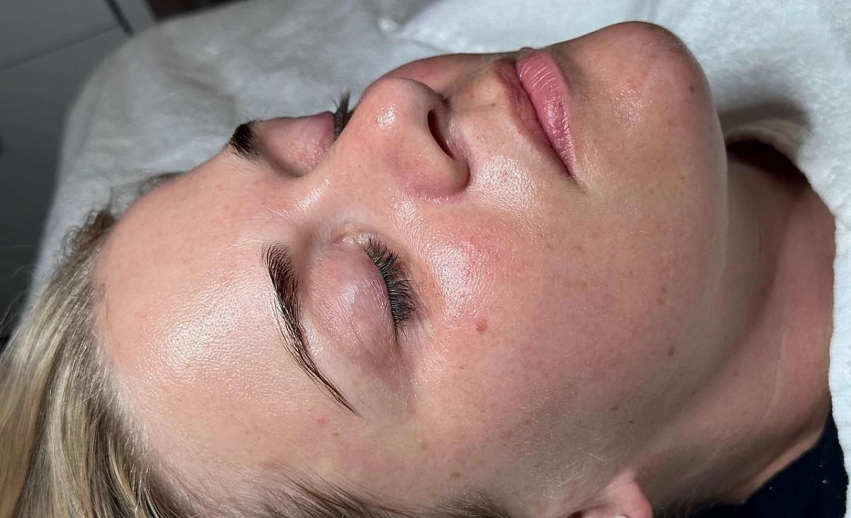 Client's face after microdermabrasion treatment.