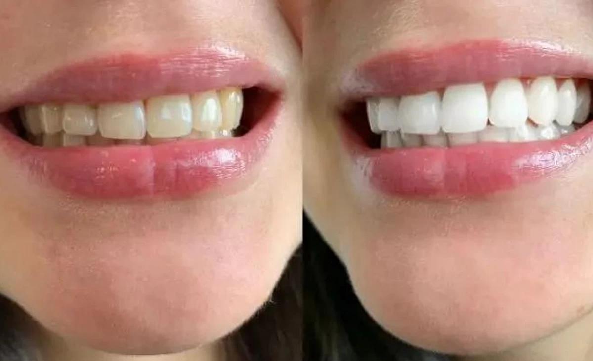 Teeth whitening at home: before/after